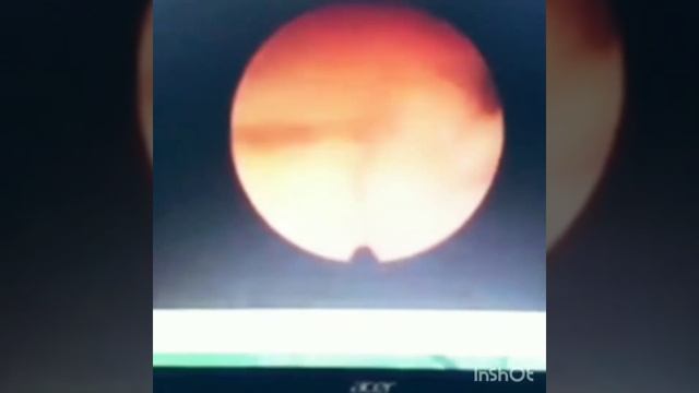 Гистероскопия в Центре ЭКО и планирования семьи "Будущее" город Ессентуки смотреть онлайн