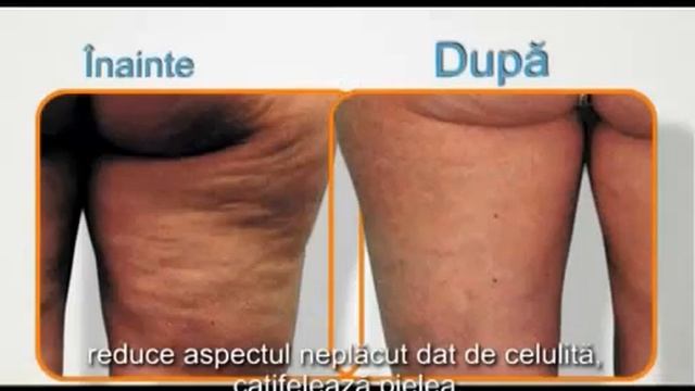Массажер антицеллюлитный Celluless Md смотреть онлайн