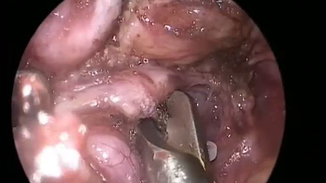 Ганглионеврома Mp4