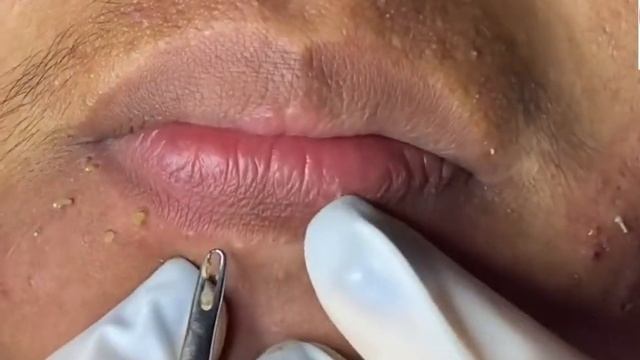 Remoção de cravo 2021 - Pimple Popping 2021 -Blackhead Removal EP0010 смотреть онлайн