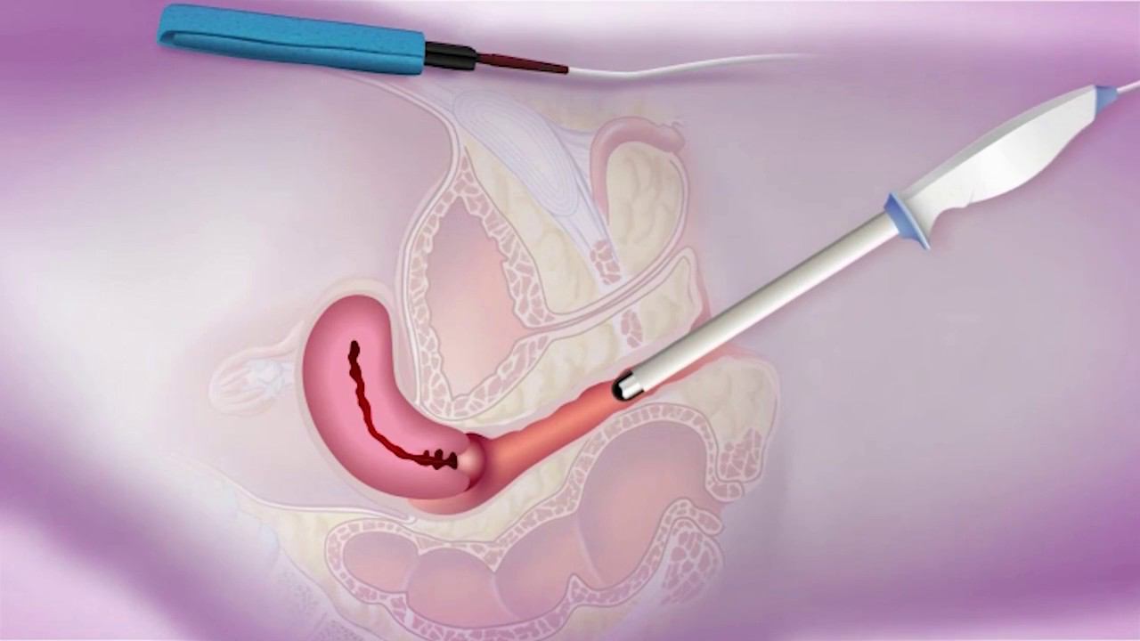 Физиотерапевтический комбайн для гинекологии - BTL-4000 Premium G смотреть онлайн