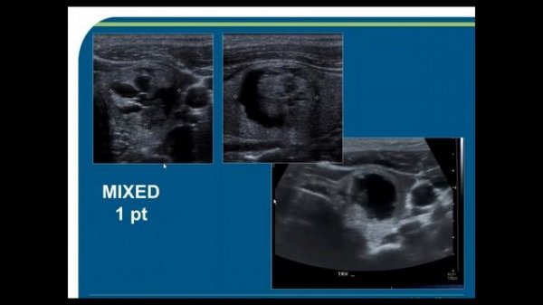 ACR TI-RADS Webinar Part I: This Is How We Do It