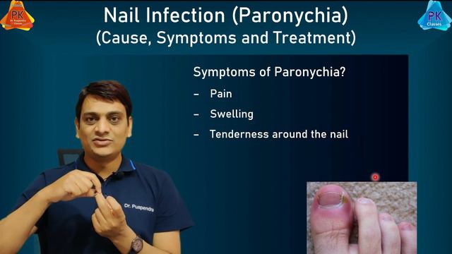 Nail Infection (Paronychia) - Cause & Treatment | नाखून संक्रमण का इलाज कैसे करें? (Dr. Puspendra) смотреть онлайн