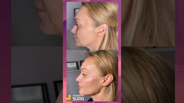 Коррекция углов нижней челюсти и коррекция подбородка смотреть онлайн