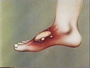 ОБЖ-НВП. Первая медицинская помощь. Первая помощь при ожогах