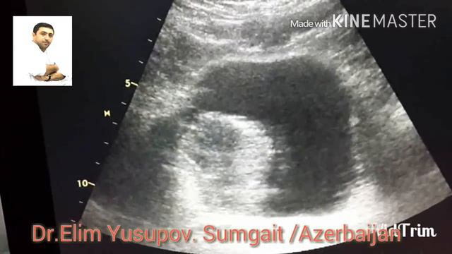 Аденокарцинома мочевого пузыря смотреть онлайн