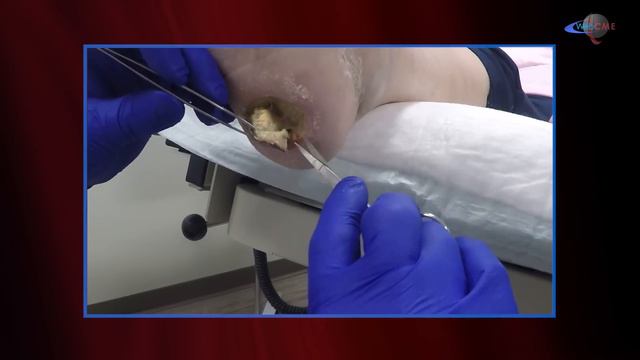 WCW: Serial Debridement Of Heel Eschar