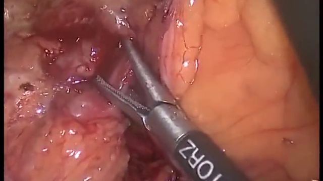 Lap Left Colectomy смотреть онлайн