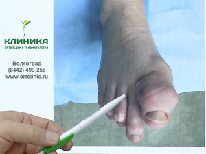 Тофусы при подагре