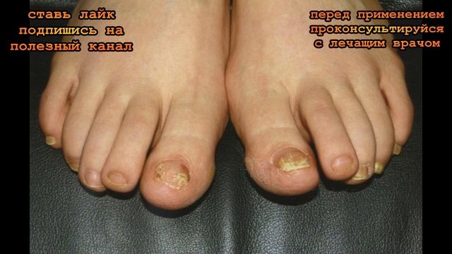 ★ Возьми тертый ХРЕН, приложи к больному ГРИБКОМ ногтю и туго перебинтуй. Лечение ГРИБКА ногтей смотреть онлайн