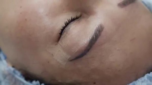 Лазерное омоложение лица Deka