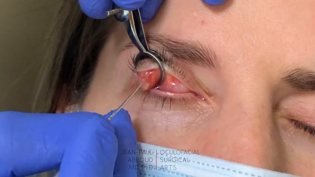 Incision and Drainage of a Chalazion/Stye смотреть онлайн