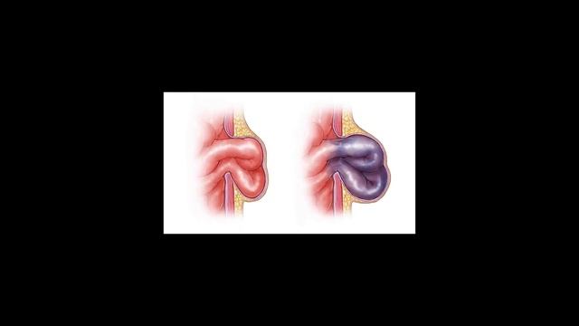 Паховые грыжи у детей. Нужно ли оперировать? смотреть онлайн