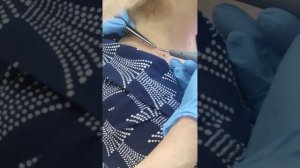 удаление папилом коагулятором