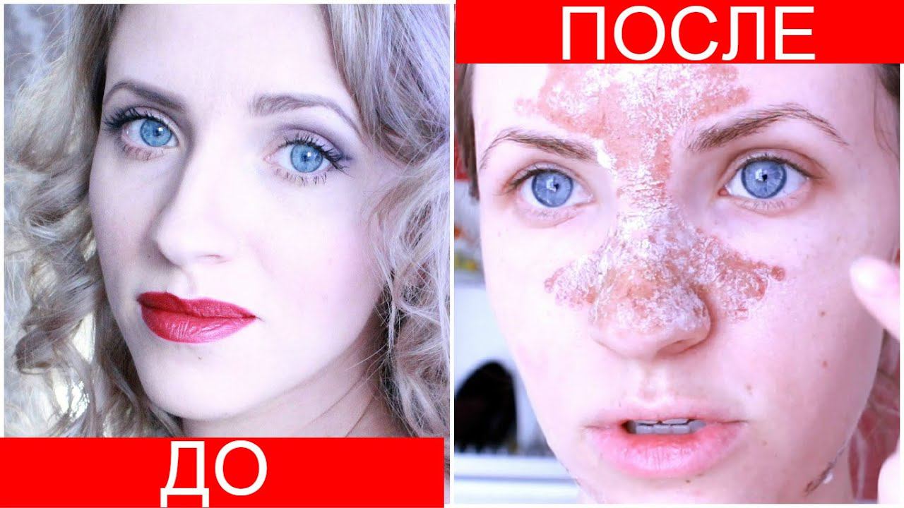 ЛАЗЕРНАЯ ШЛИФОВКА. ПОРЫ и ПостАкне. ВИДЕО ДНЕВНИК с 1-60 день. смотреть онлайн