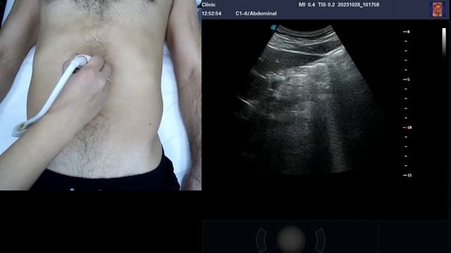 УЗИ органов брюшной полости с демонстрацией установки датчика. смотреть онлайн