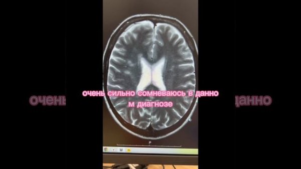 Лечим глиоз и очаги глиоза в головном мозге