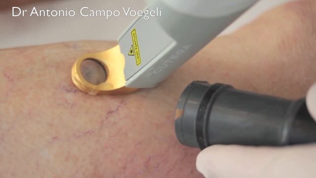 Vein treatment with Cutera's Excel V (1064nm). смотреть онлайн