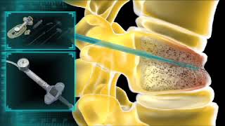 Кифопластика