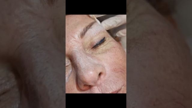 PEELING AU PHENOL смотреть онлайн