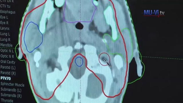 Онкологичен и лъчетерапевтичен център към УМБАЛ 
