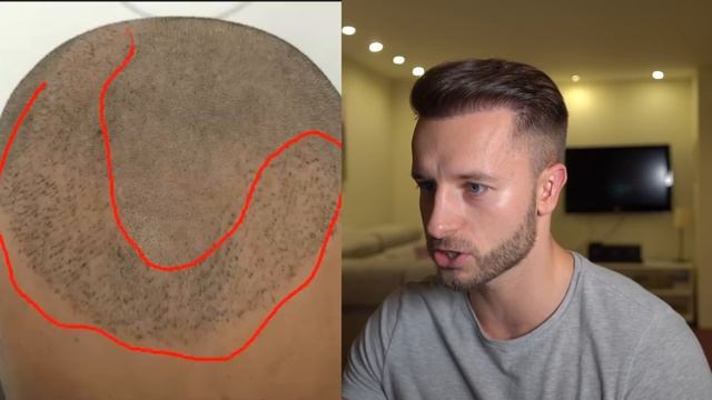 Buzz Cut After A Correct Vs Failed Hair Transplant!