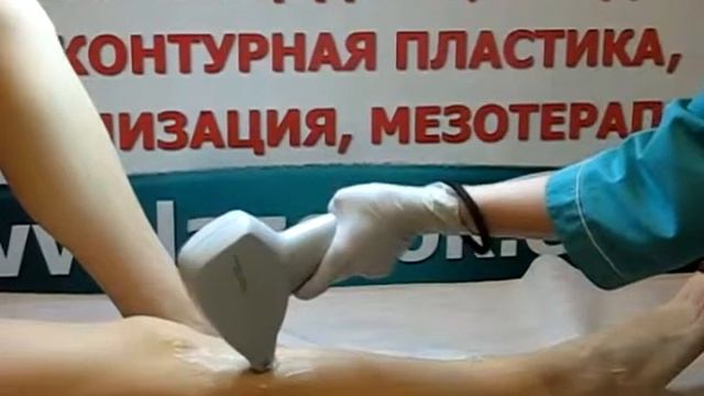 Лазерная эпиляция ног- ЛазерОК-Киев смотреть онлайн