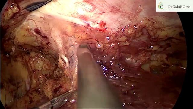 ETEP R TAR for Re-recurrent RIF hernia смотреть онлайн