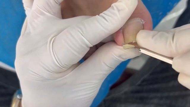 Long,thick and yellow nails removal without pain. Ingrown toenail removal and fungal nail treatment смотреть онлайн