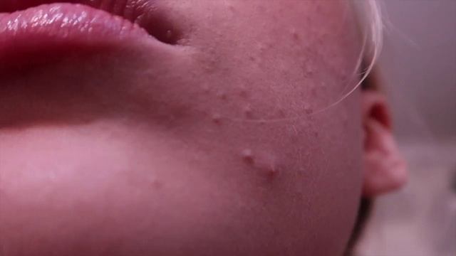 Neutrogena Rapid Wrinkle Repair Review!! *not Sponsored* // Retinol For Acne // 3 Month Progress!