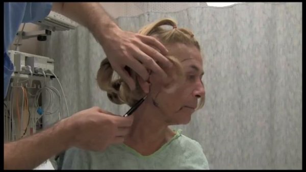 Video Journey: Deep Plane Face lift, Part 2 (Standard Definition)