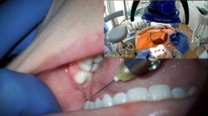 проводниковая анестезия