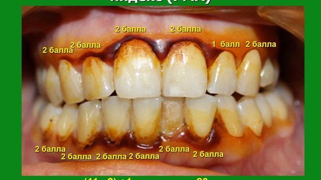 Лекция Оценка состояния тканей пародонта Пародонтальные индексы смотреть онлайн