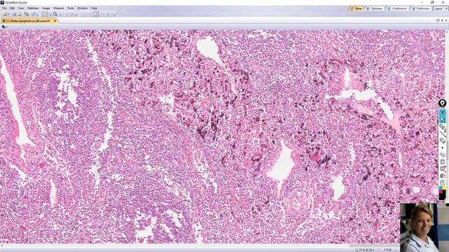 nodulus lymphaticus (lymfatická uzlina) смотреть онлайн