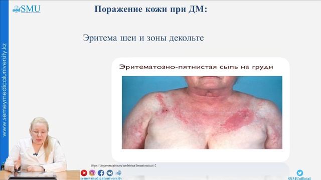 Дерматомиозит