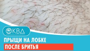? Прыщи на лобке после бритья. Клинический случай №930