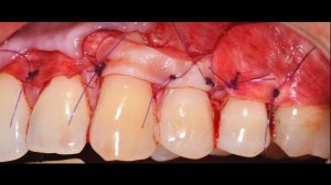 Хирургическое лечение рецессии десны 3.4