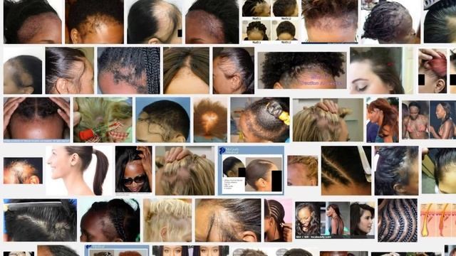 If you don't want to go bald then avoid THIS hairstyle like the plague смотреть онлайн