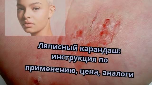 Ляписный карандаш: инструкция по применению, цена, аналоги смотреть онлайн