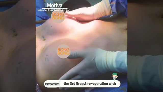 The Third Breast Reoperation Story.(Motiva) смотреть онлайн