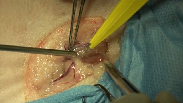 Inguinal lymph node resection in a dog by electrosurgery. смотреть онлайн