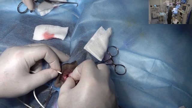 Гидроцефалия постановка шунта. смотреть онлайн