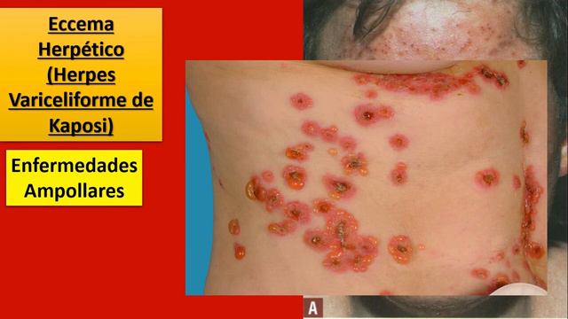 Herpes Simplex parte 2: Clínica смотреть онлайн