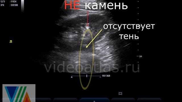 НЕ Камень в почке смотреть онлайн