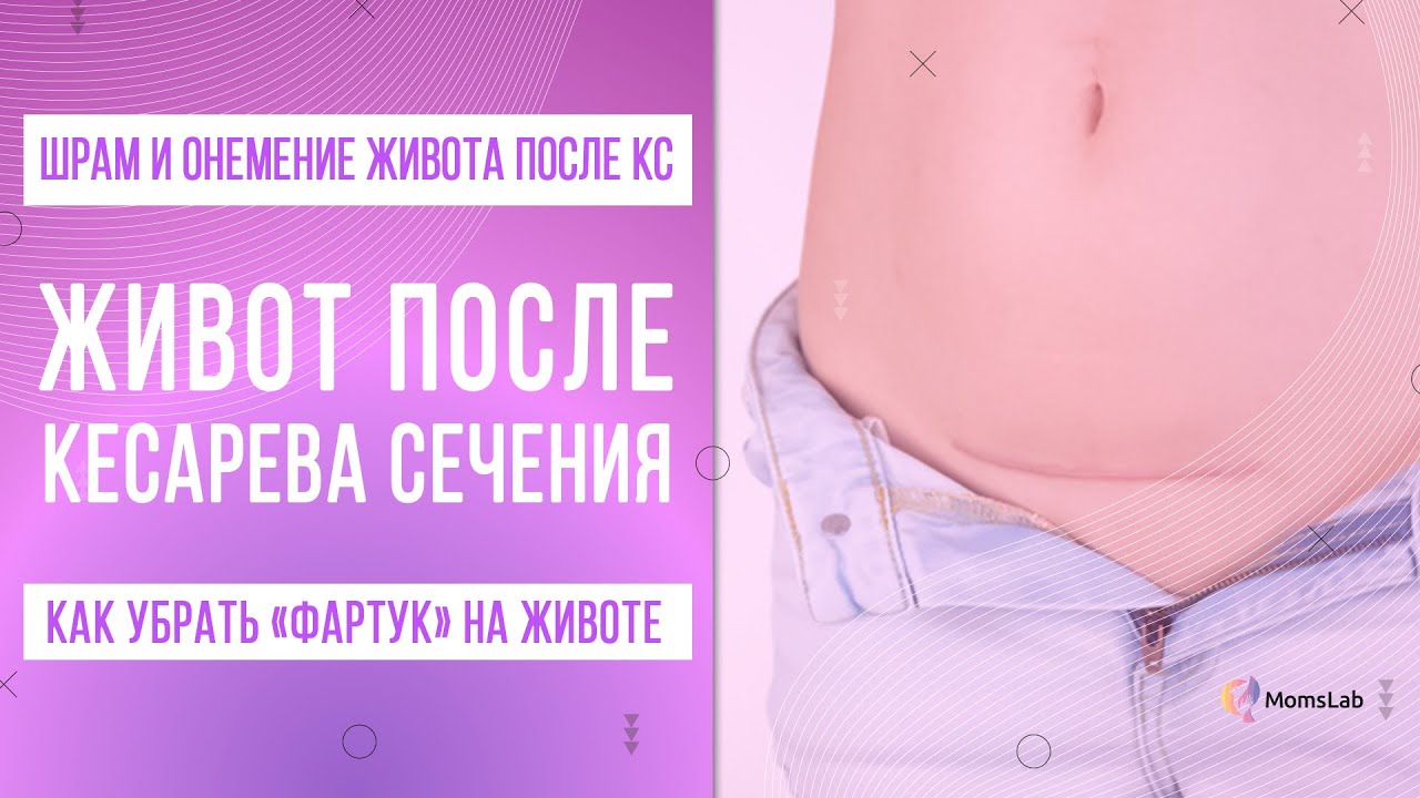 «Фартук» на животе после КС. Как убрать валик над шрамом после кесарева сечения?
