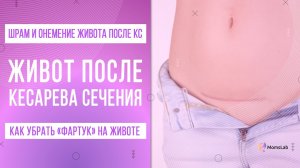 «Фартук» на животе после КС. Как убрать валик над шрамом после кесарева сечения?