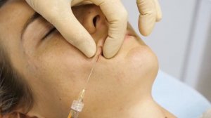 Биоревитализация (увлажнение) губ