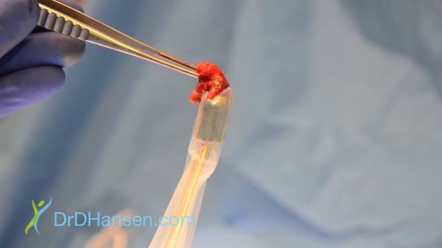 Breast Cancer Lumpectomy and Sentinel Lymph Node Biopsy, Darrin Hansen MD, Salt Lake City Utah смотреть онлайн
