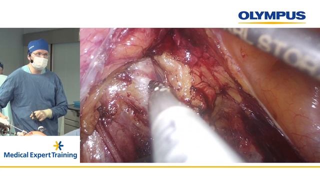 Вебинар по техническим аспектам лапароскопической тазовой лимфаденэктомии в онкогинекологии смотреть онлайн