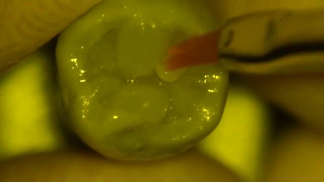 Моделирование 2 й нижний премоляр / modeling of second lower premolar смотреть онлайн